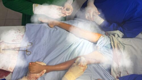 খাগড়াছড়িতে শিশুদের ফ্রি অর্থোপেডিক চিকিৎসা ক্যাম্পের দৃশ্য